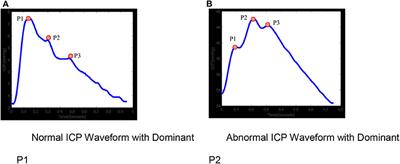 Intracranial Pressure Monitoring Signals After Traumatic Brain Injury: A Narrative Overview and Conceptual Data Science Framework